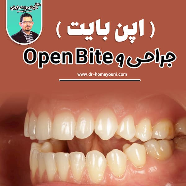 جراحی و open bite ( اپن بایت )