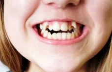هزينه و قيمت ارتودنسى 1 07B518D1 9EAD 439E BDD6 AAE6DC5F9916