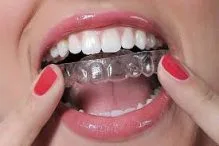 مدت زمان درمان با ارتودنسی نامرئی 1 A70B5AD6 2581 4723 8DEB C90CFAEB509F