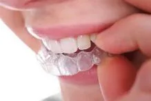 تکنینک ارتودنسی نامرئی 1 C1AF45C1 5924 4929 B9D2 C7C1BB7551B8