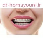تصورات نادرست درباره ارتودنسی 1 پرکردن دندان ارتودنسی