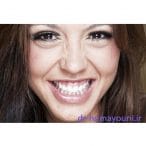 درمان لبخند لثه ای (gummy smile)
