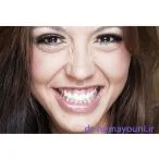 درمان لبخند لثه ای (gummy smile) 1 Untitled 17