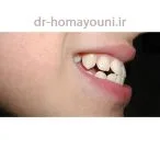 مال اکلوژن دندان 1 Untitled 29