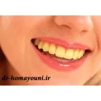 زرد شدن دندان ها حین ارتودنسی 1 Untitled 43