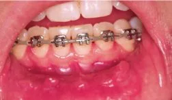 محدودیت های غذایی و زخم حین درمان ارتودنسی 1 EGREHER