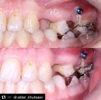 اینتروژن سگمنت