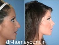 ارتودنسی و عمل جراحی بینی