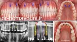 نقش ارتودنسی در دندانپزشکی ایمپلنت 1 Untitled 68 1