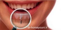 مراقبت های لازم بعد از ایمپلنت 1 Untitled 69