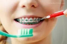 بهداشت ارتودنسی در مسافرت 1 images 19