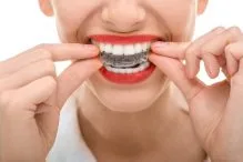 آیا بعد از درمان ارتودنسی استفاده از پلاکهای متحرک ضرورت دارد 1 orthodontics southend