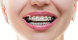 آیا ارتودنسی روش مناسبی برای پیشگیری از بیماریهای فک و دندان است؟ 1 photo 102