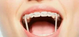 کاربرد الاستیک ها در ارتودنسی 1 photo 103