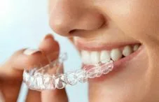 روش درمان ارتودنسی نامرئی(الاینر همرو) 1 photo 86 e1552741478695