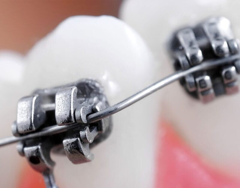orthodontist-s13 ارتودنسی چیست؟