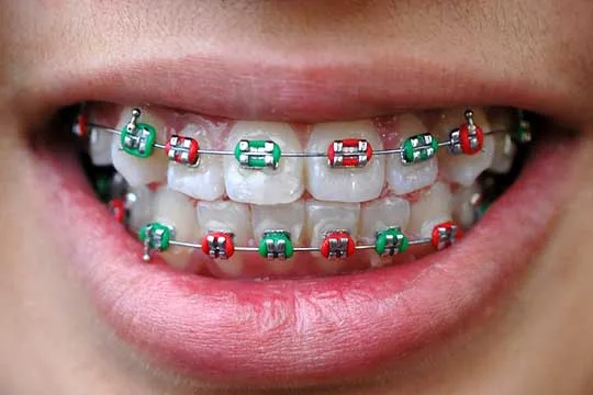 تغییر رنگ کش ها در ارتودنسی 1 photo 1000