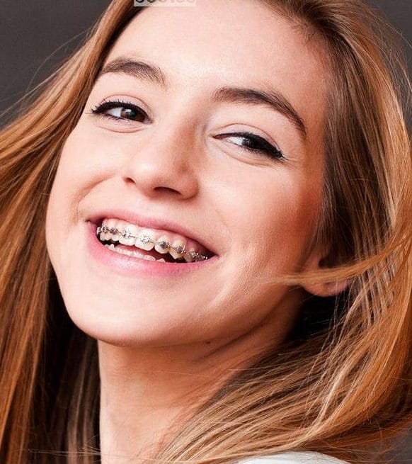 مراقبت‌های حین ارتودنسی