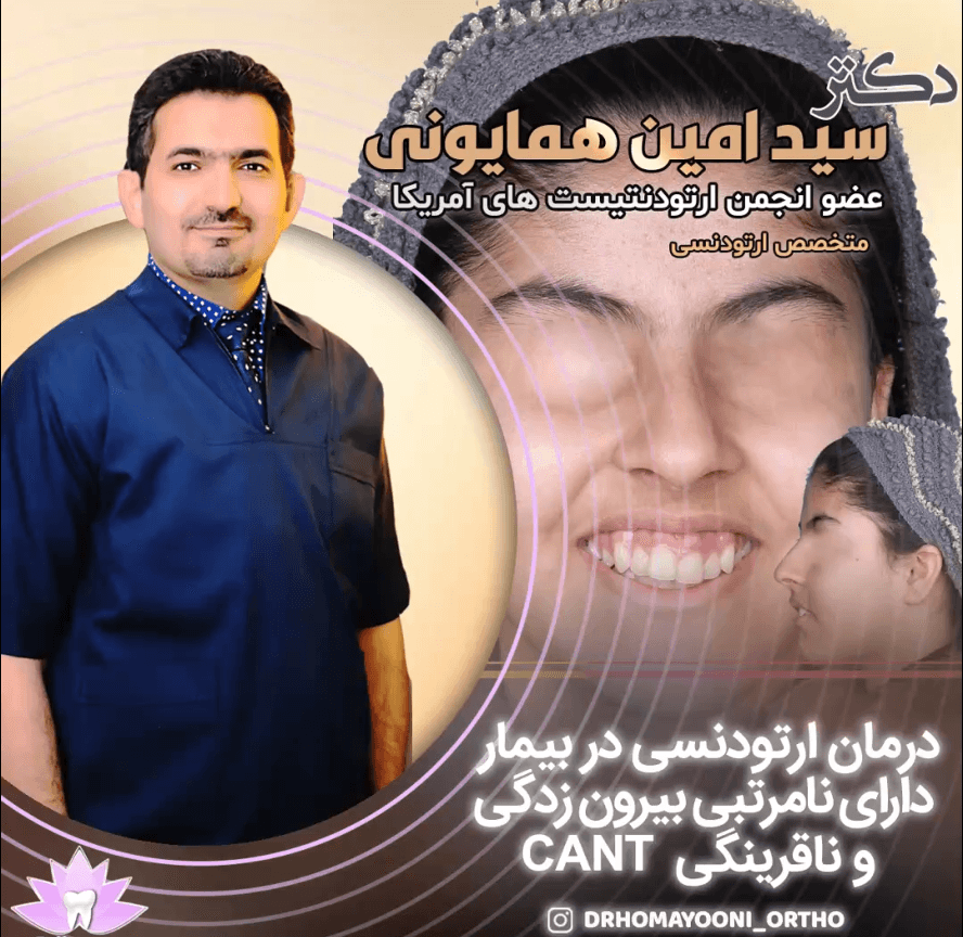درمان ارتودنسی در بیمار دارای نامرتبی بیرون زدگی و ناقرینگی cant