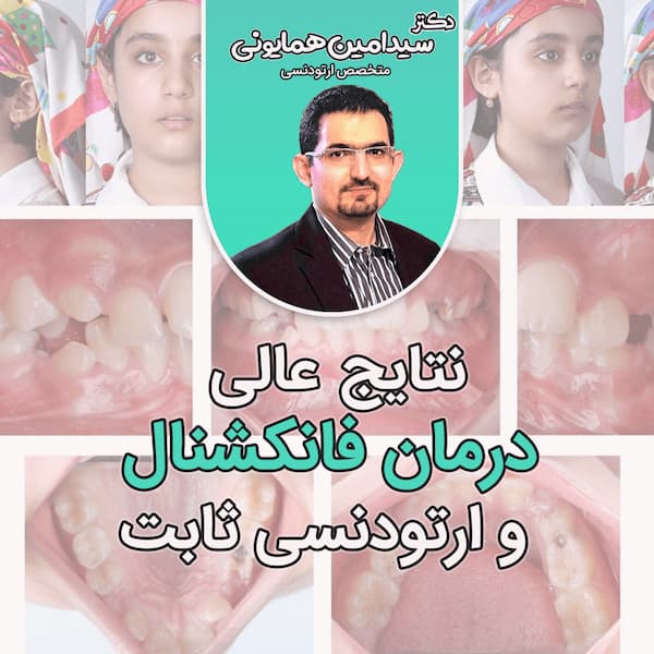 نتایج  عالی درمان فانکشنال و ارتودنسی ثابت
