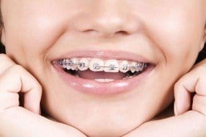 32adjortodensifathian-300x200-300x200 بهداشت ارتودنسی در تعطیلات