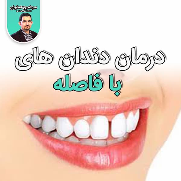 فاصله بین دندان ها و درمان آن