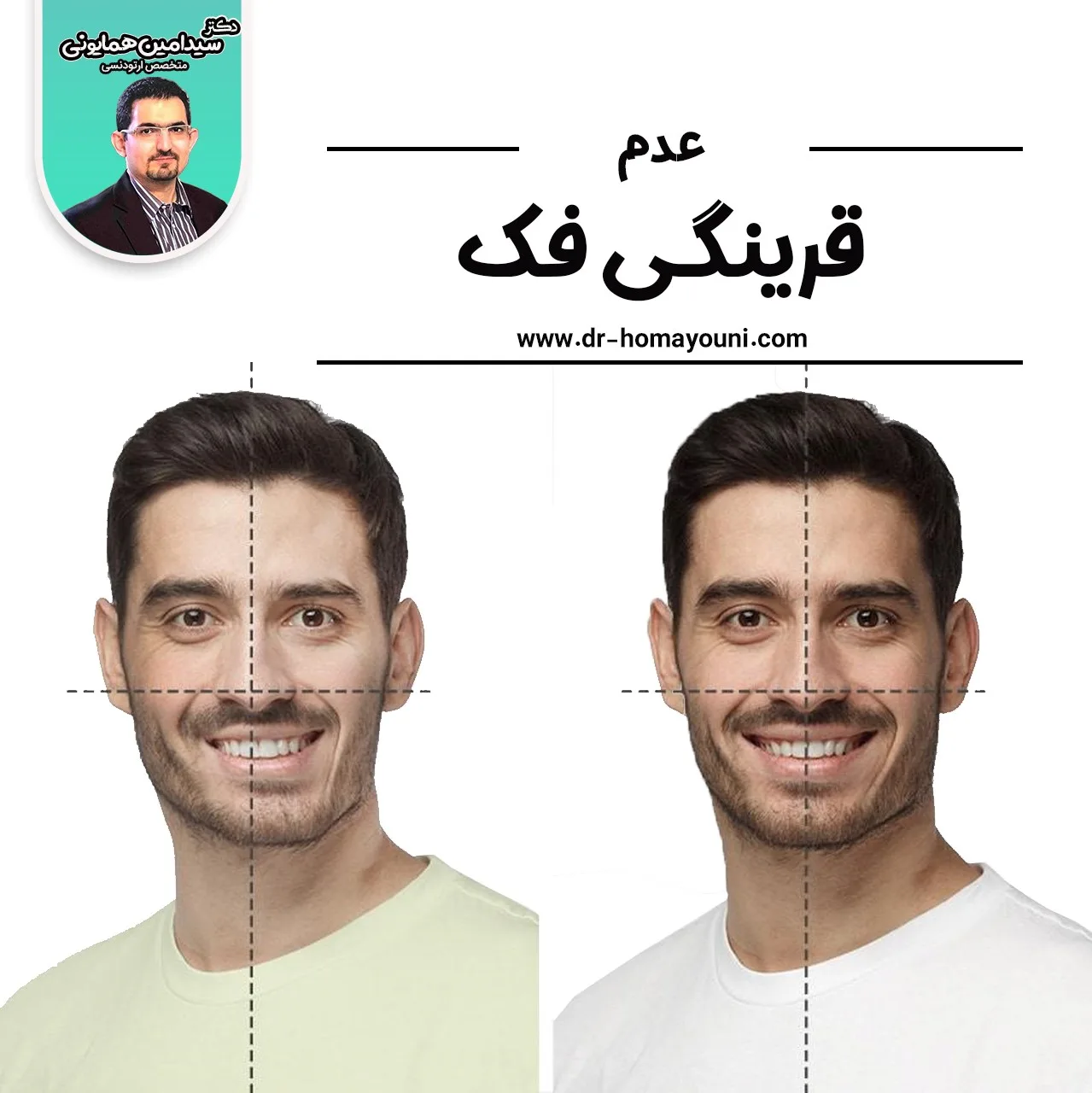 عدم قرینگی فک 1 عدم قرینگی فک