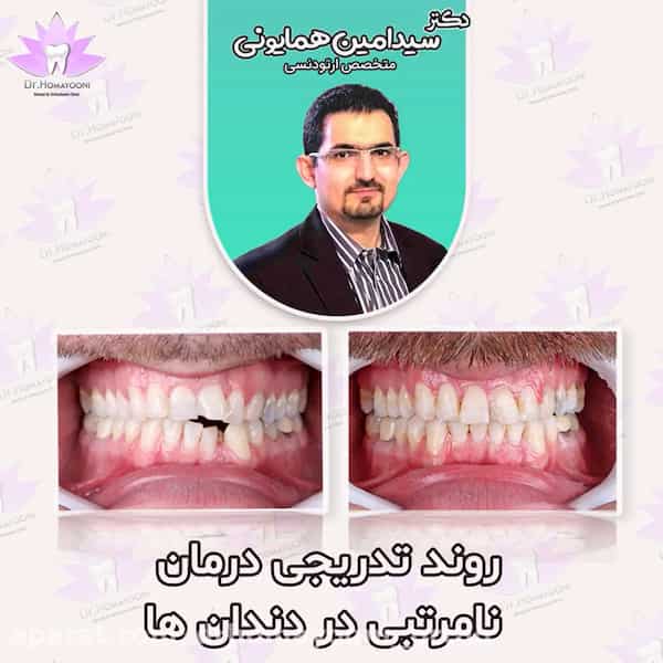 تغییرات تدریجی نامرتبی دندان ها به  کمک ارتودنسی