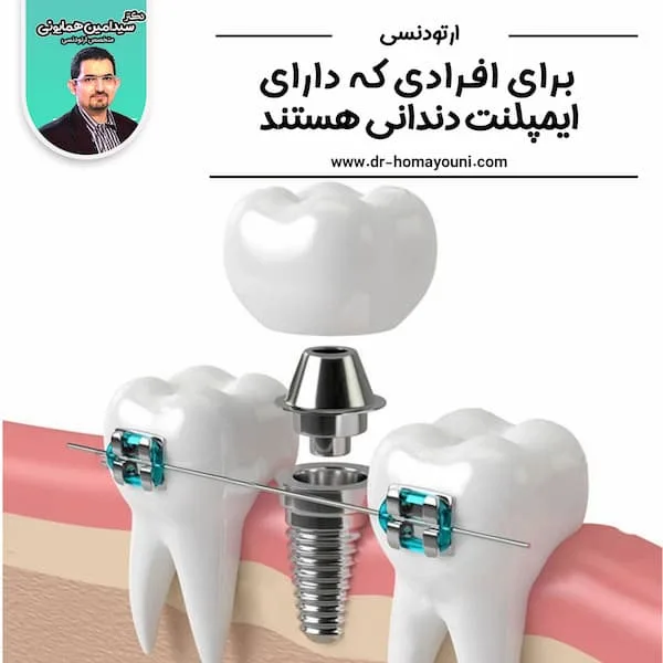 ارتودنسی برای افرادی که دارای ایمپلنت دندانی هستند 1 برای افرادی که دارای ایمپلنت دند انی هستند