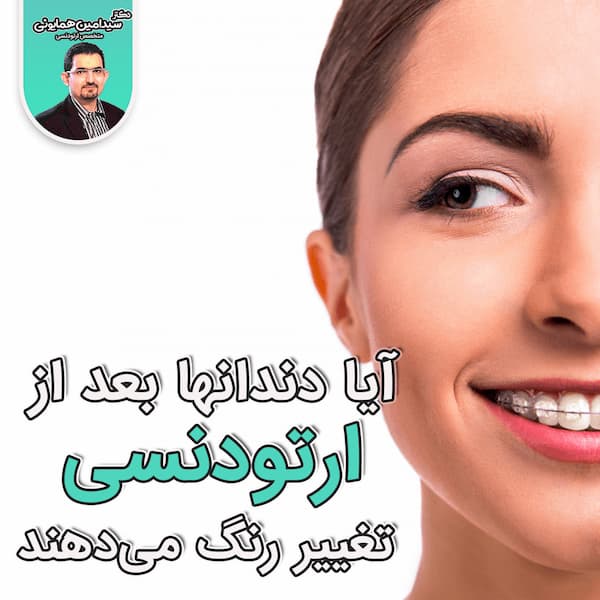 تغییر رنگ هنگام اروتودنسی