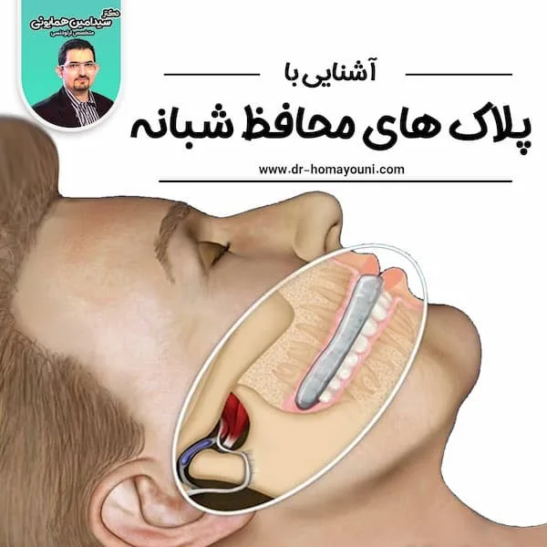 آشنایی با پلاک های محافظ شبانه (night guard) 1 پلاک های محافظ شبانه