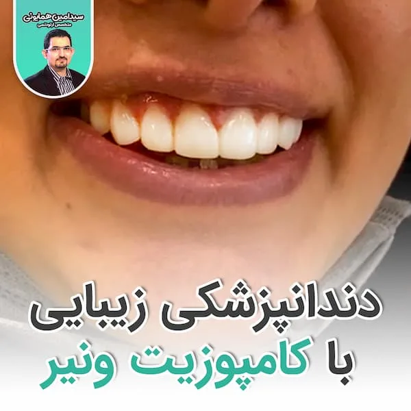 دندانپزشکی زیبایی با کامپوزیت ونیر