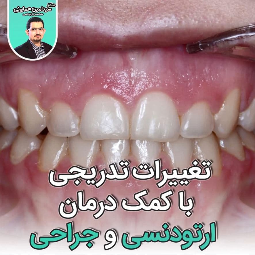 تغییرات تدریجی به کمک درمان ارتودنسی و جراحی