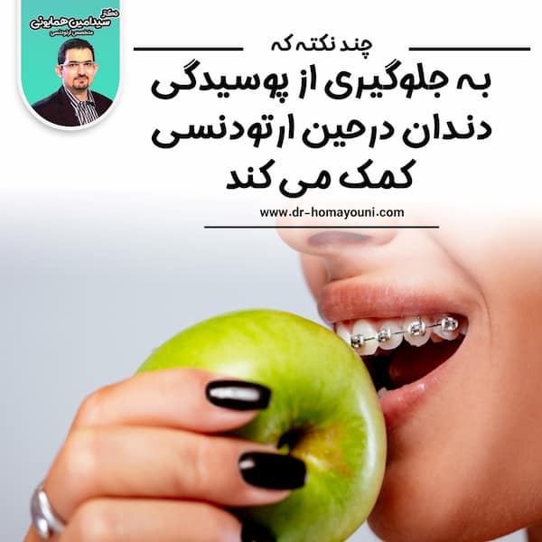 چند نکته که به جلوگیری از پوسیدگی دندان درحین ارتودنسی کمک می کند: