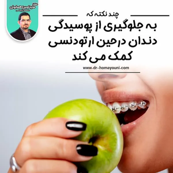 چند نکته که به جلوگیری از پوسیدگی دندان درحین ارتودنسی کمک می کند: 1 پوسیدگی