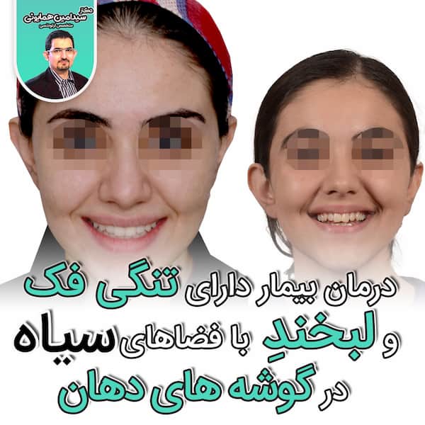 گوشه سیاه