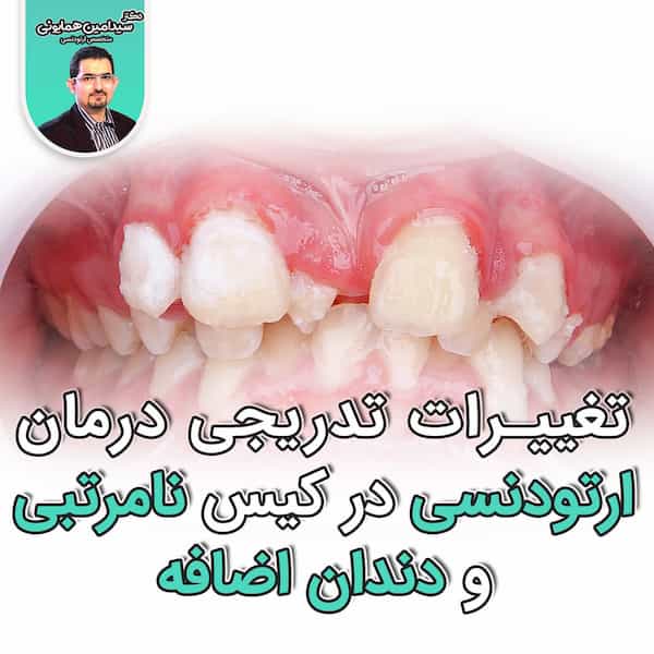 تغییرات تدریجی درمان ارتودنسی در کیس نامرتبی و دندان اضافه