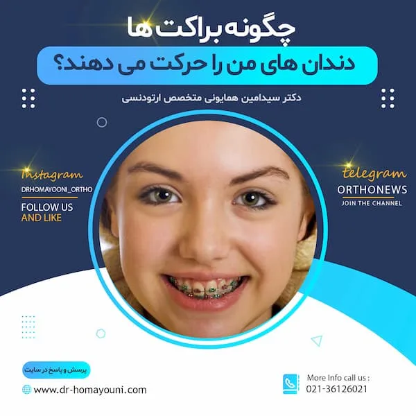 چگونه براکت ها دندان های من را حرکت می دهند؟ 1 قالب جدید دکتر همایونی 1400