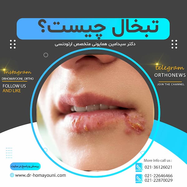 تبخال چیست؟