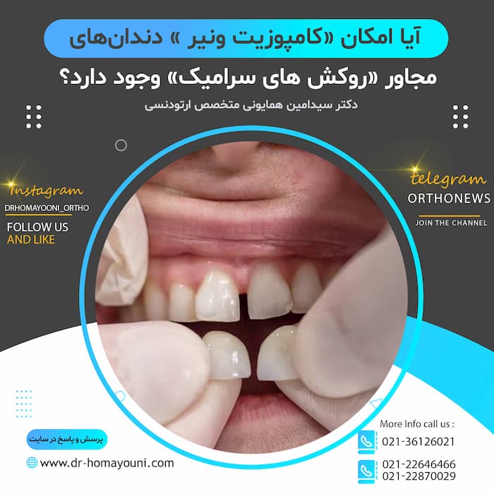 آیا امکان «کامپوزیت ونیر » دندان‌های مجاور «روکش های سرامیک» وجود دارد؟