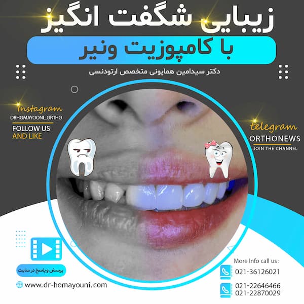 با کامپوزیت ونیر copy