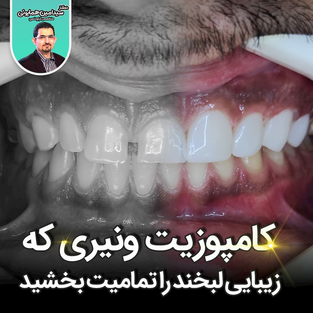 کامپوزیت ونیری که زیبایی لبخند را تمامیت بخشید