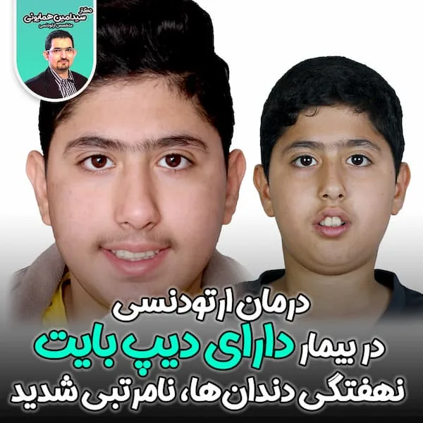 درمان ارتودنسی در بیمار دارای دیپ بایت، نهفتگی دندان_ها، نامرتبی شدید