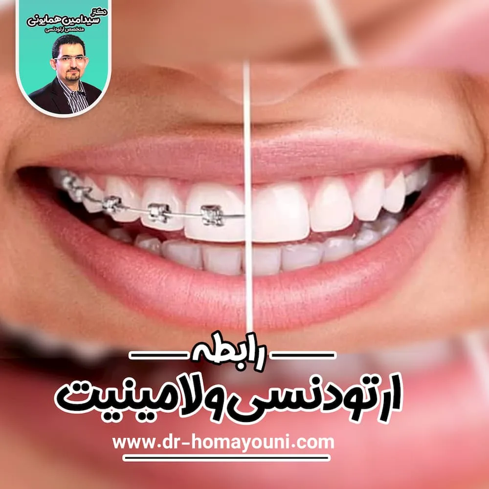 رابطه ارتودنسی و لامینیت 1 رابطه ارتودنسی و لامنتیت