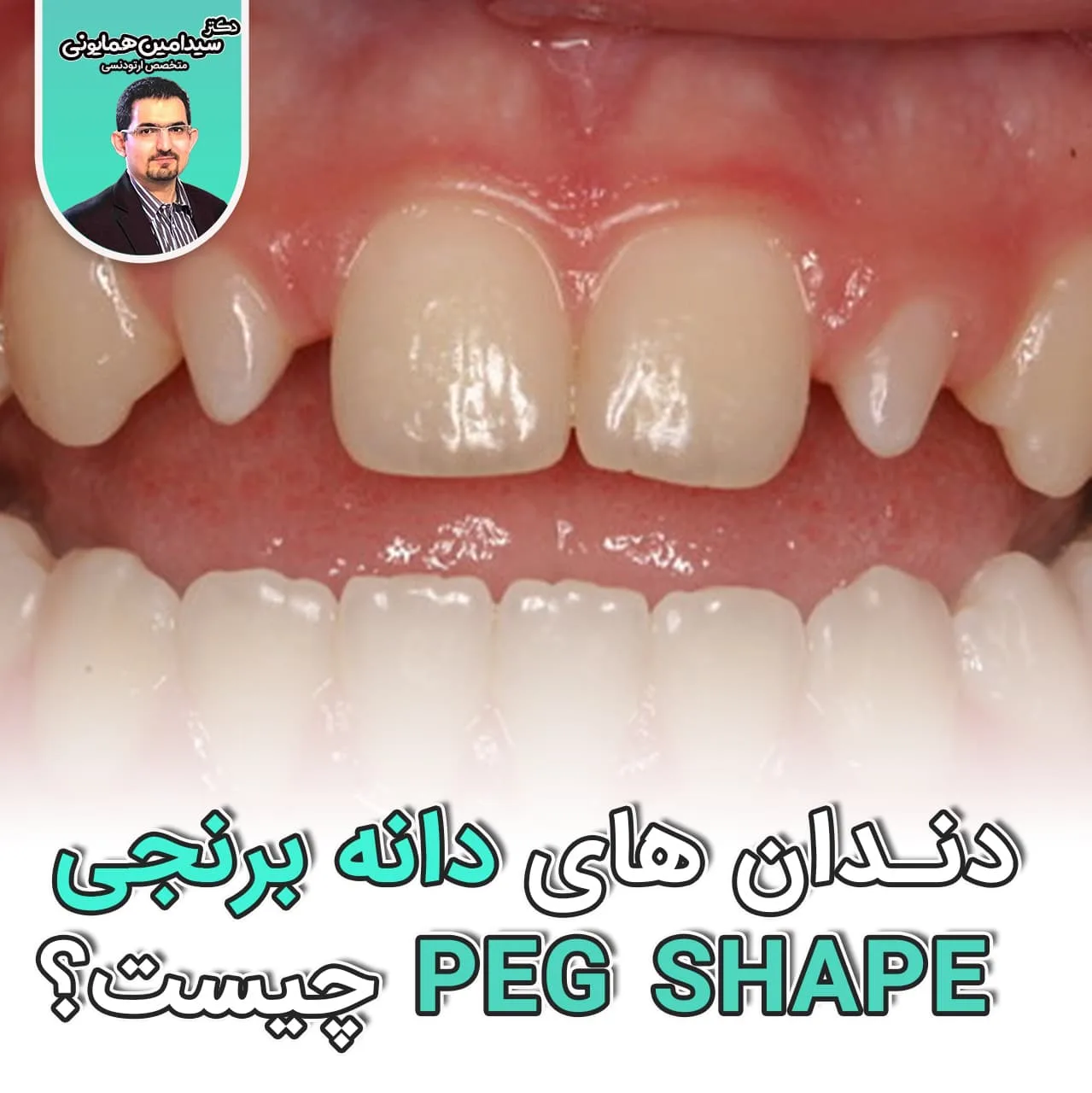 دندان های برنجی (PEG SHAPE)چیست؟ 1 زیبایی شگفت انگیز