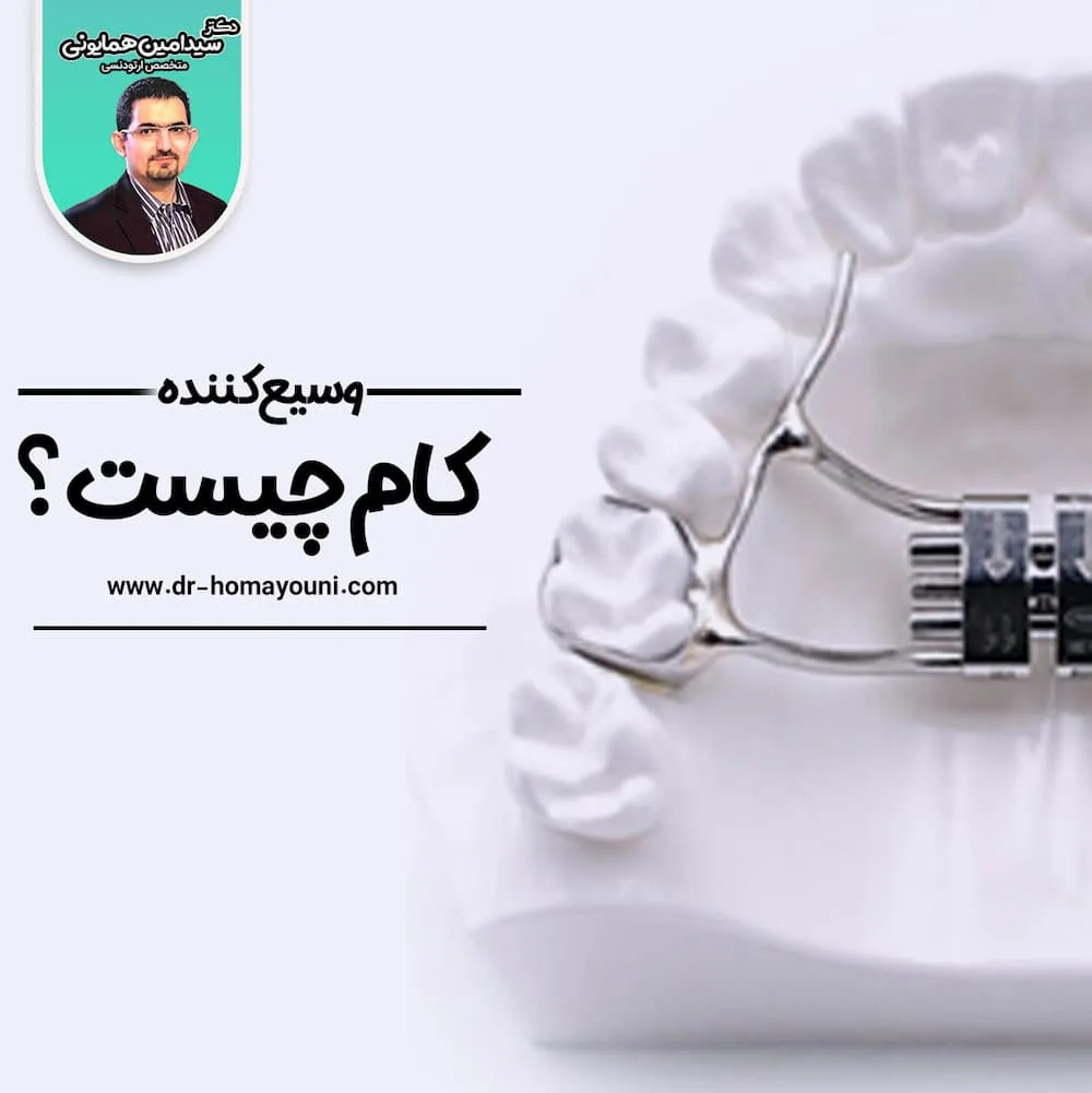 وسیع کننده کام چیست؟ 1 وسیع کننده کام