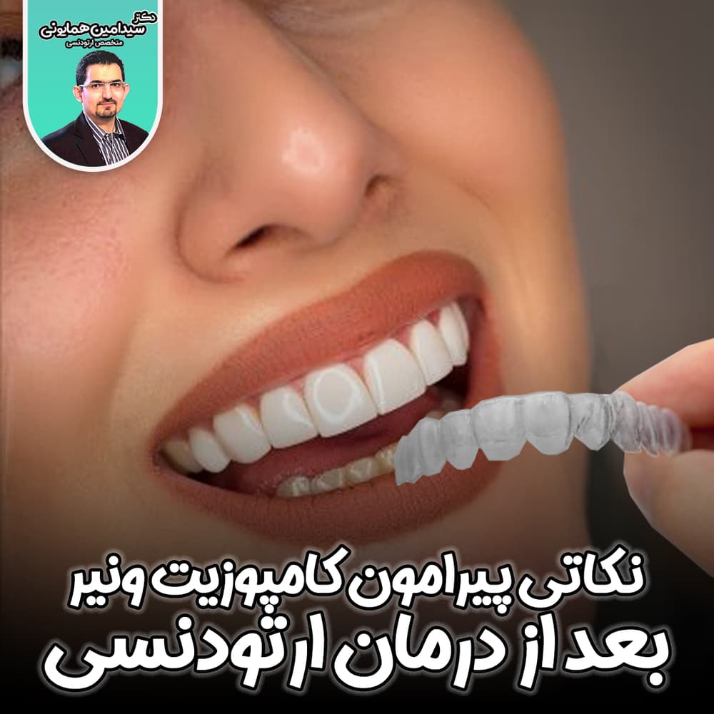کامپوزیت ونیر