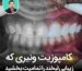 کامپوزیت ونیری که زیبایی لبخند را تمامیت بخشید