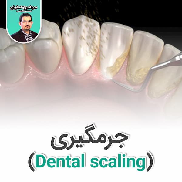 جرمگیری (Dental scaling)