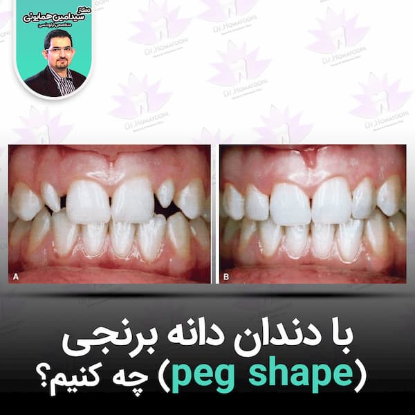 با دندان دانه برنجی چیکار کنیم؟